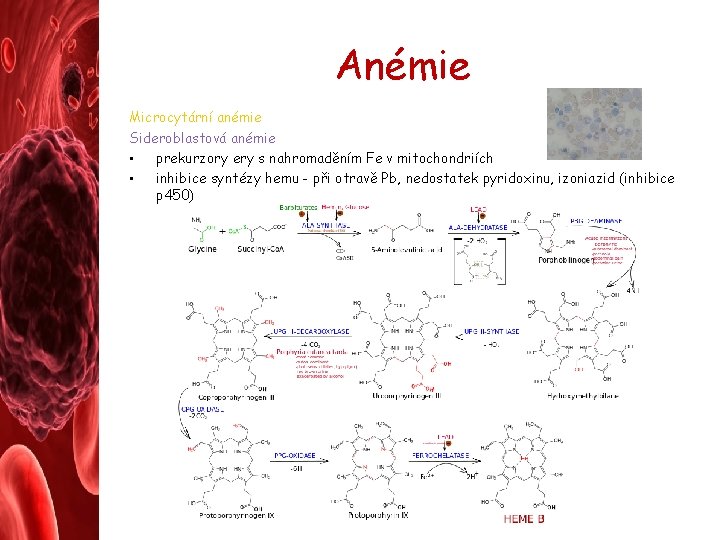 Anémie Microcytární anémie Sideroblastová anémie • prekurzory ery s nahromaděním Fe v mitochondriích •