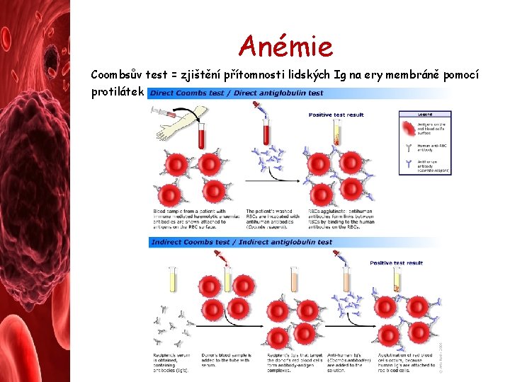 Anémie Coombsův test = zjištění přítomnosti lidských Ig na ery membráně pomocí protilátek 