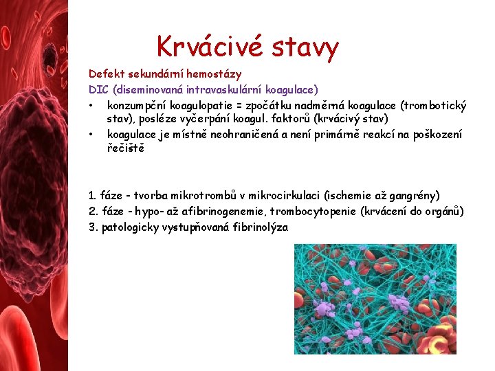 Krvácivé stavy Defekt sekundární hemostázy DIC (diseminovaná intravaskulární koagulace) • konzumpční koagulopatie = zpočátku