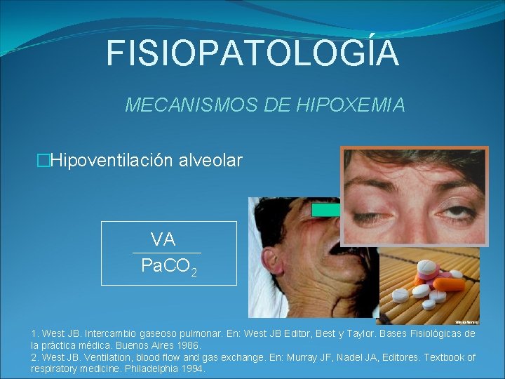 FISIOPATOLOGÍA MECANISMOS DE HIPOXEMIA �Hipoventilación alveolar VA Pa. CO 2 1. West JB. Intercambio