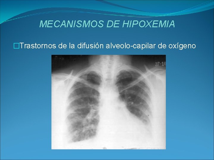 MECANISMOS DE HIPOXEMIA �Trastornos de la difusión alveolo-capilar de oxígeno 