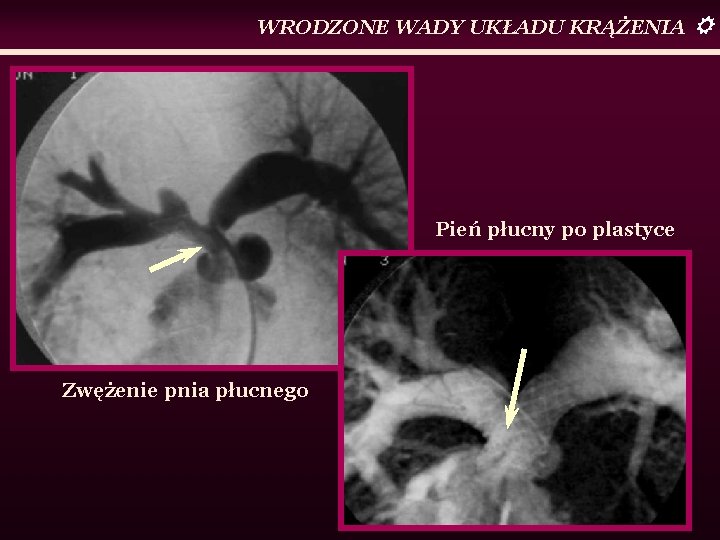 WRODZONE WADY UKŁADU KRĄŻENIA Pień płucny po plastyce Zwężenie pnia płucnego 