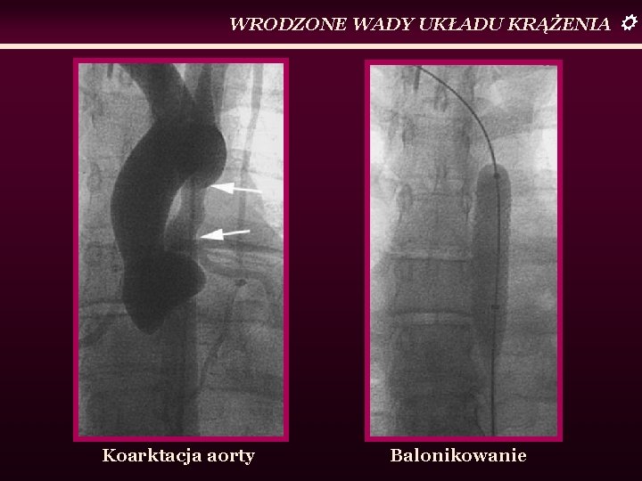 WRODZONE WADY UKŁADU KRĄŻENIA Koarktacja aorty Balonikowanie 