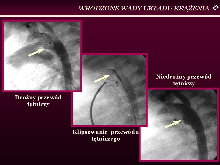 WRODZONE WADY UKŁADU KRĄŻENIA Niedrożny przewód tętniczy Drożny przewód tętniczy Klipsowanie przewódu tętniczego 