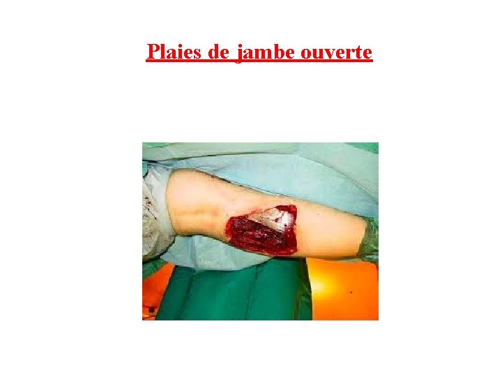 Plaies de jambe ouverte 