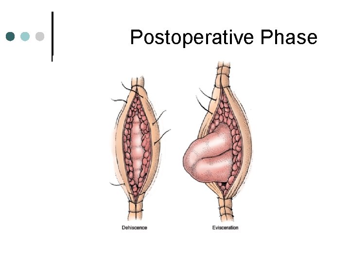 Postoperative Phase Postoperative Phase