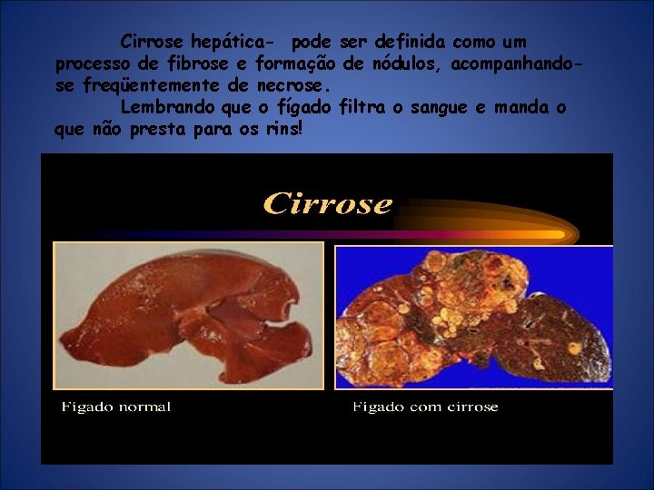 Cirrose hepática- pode ser definida como um processo de fibrose e formação de nódulos,