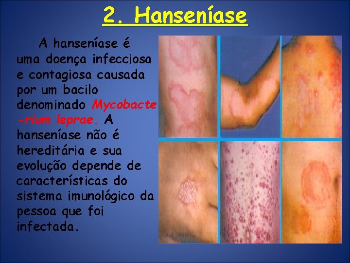 2. Hanseníase A hanseníase é uma doença infecciosa e contagiosa causada por um bacilo 2. Hanseníase A hanseníase é uma doença infecciosa e contagiosa causada por um bacilo