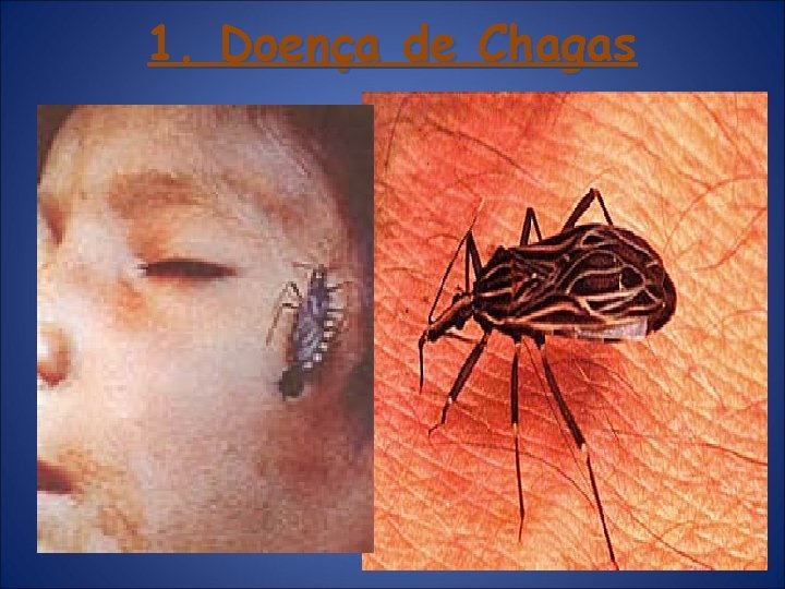 1. Doença de Chagas 