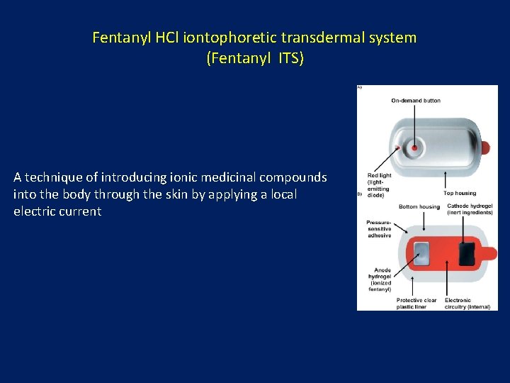 Fentanyl HCl iontophoretic transdermal system (Fentanyl ITS) A technique of introducing ionic medicinal compounds