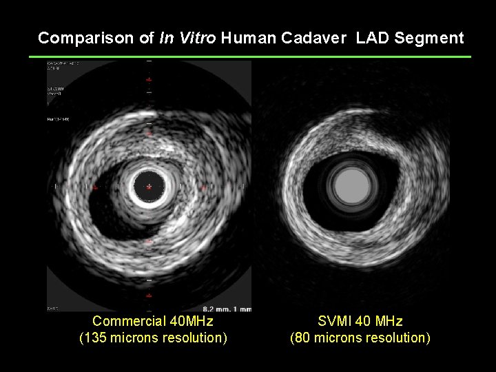 Comparison of In Vitro Human Cadaver LAD Segment Commercial 40 MHz (135 microns resolution)