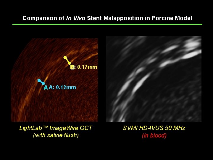 Comparison of In Vivo Stent Malapposition in Porcine Model B: 0. 17 mm A: