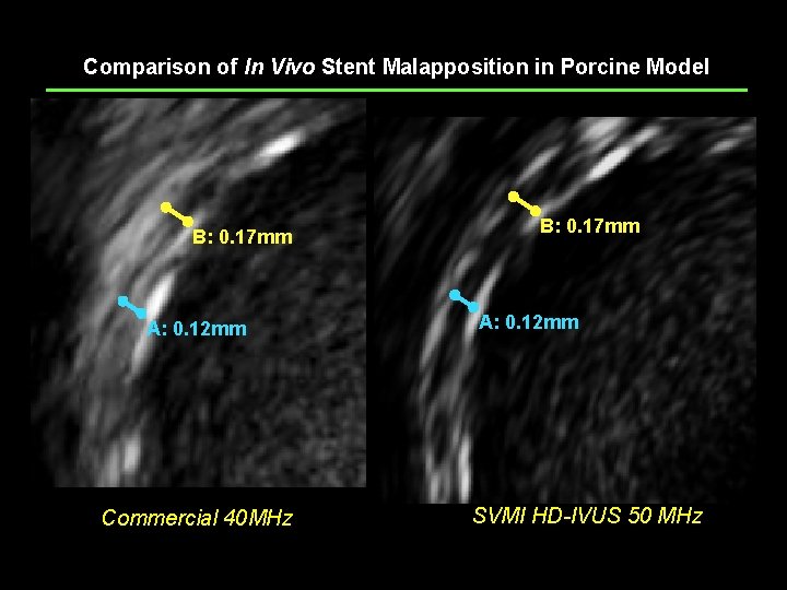 Comparison of In Vivo Stent Malapposition in Porcine Model B: 0. 17 mm A: