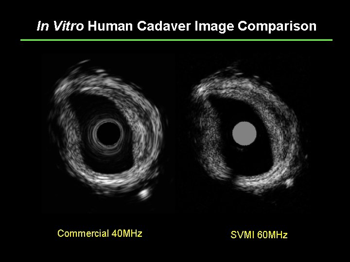 In Vitro Human Cadaver Image Comparison Commercial 40 MHz Confidential SVMI 60 MHz 11/30/2020