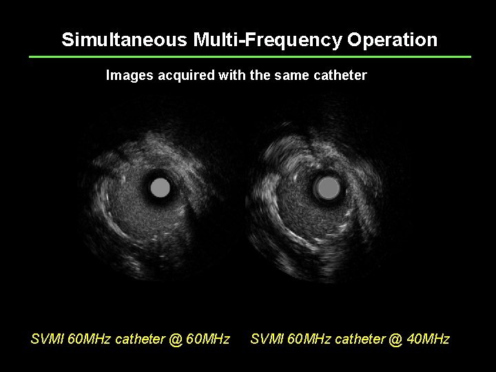 Simultaneous Multi-Frequency Operation Images acquired with the same catheter SVMI 60 MHz catheter @