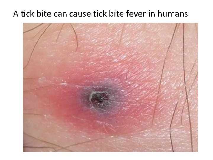 A tick bite can cause tick bite fever in humans 