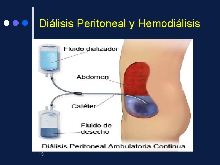 Diálisis Peritoneal y Hemodiálisis 19 