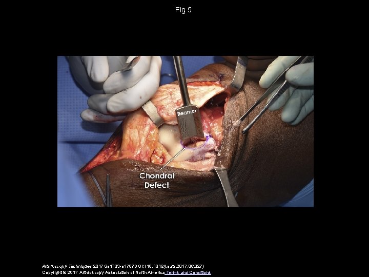 Fig 5 Arthroscopy Techniques 2017 6 e 1703 -e 1707 DOI: (10. 1016/j. eats.