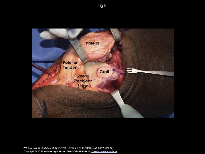 Fig 8 Arthroscopy Techniques 2017 6 e 1703 -e 1707 DOI: (10. 1016/j. eats.