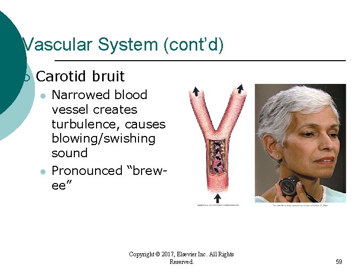 Vascular System (cont’d) ¡ Carotid bruit l l Narrowed blood vessel creates turbulence, causes Vascular System (cont’d) ¡ Carotid bruit l l Narrowed blood vessel creates turbulence, causes