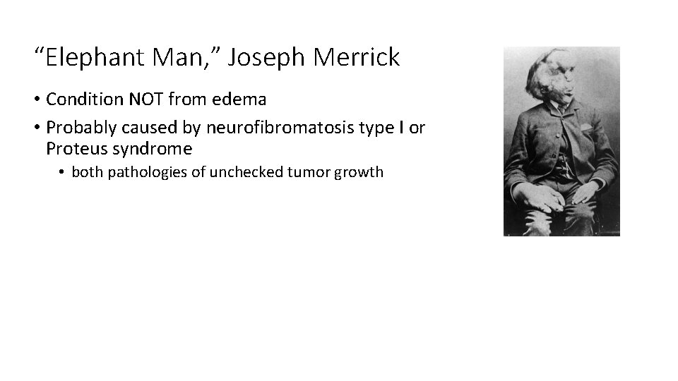 “Elephant Man, ” Joseph Merrick • Condition NOT from edema • Probably caused by