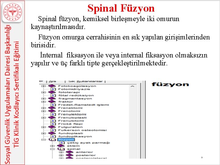 Spinal Füzyon Spinal füzyon, kemiksel birleşmeyle iki omurun kaynaştırılmasıdır. Füzyon omurga cerrahisinin en sık