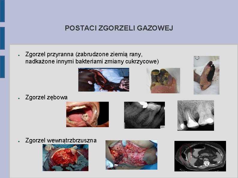 POSTACI ZGORZELI GAZOWEJ ● Zgorzel przyranna (zabrudzone ziemią rany, nadkażone innymi bakteriami zmiany cukrzycowe)