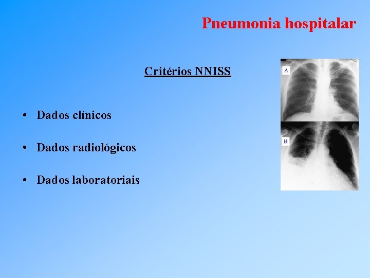 Pneumonia hospitalar Critérios NNISS • Dados clínicos • Dados radiológicos • Dados laboratoriais 