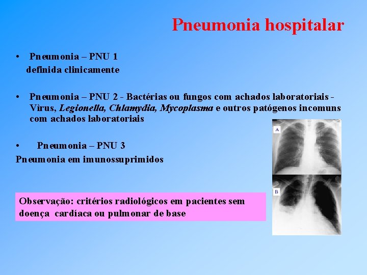 Pneumonia hospitalar • Pneumonia – PNU 1 definida clinicamente • Pneumonia – PNU 2