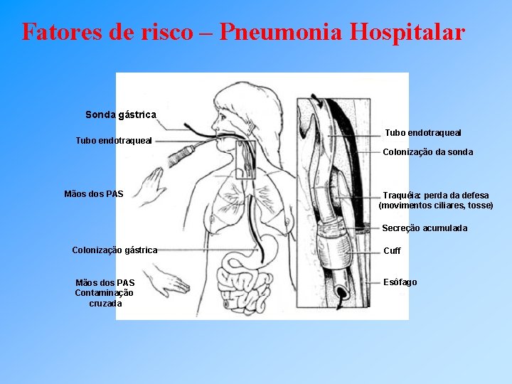 Fatores de risco – Pneumonia Hospitalar Sonda gástrica Tubo endotraqueal Colonização da sonda Mãos
