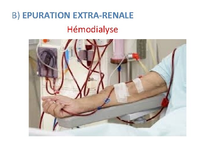 B) EPURATION EXTRA-RENALE Hémodialyse 