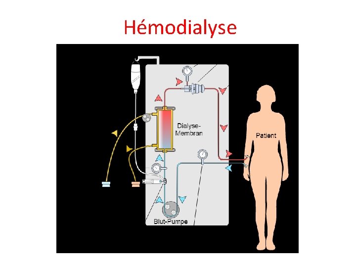  Hémodialyse 