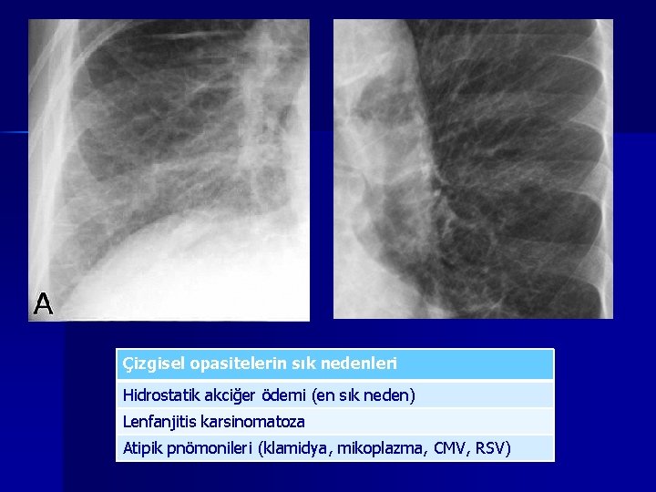 Çizgisel opasitelerin sık nedenleri Hidrostatik akciğer ödemi (en sık neden) Lenfanjitis karsinomatoza Atipik pnömonileri