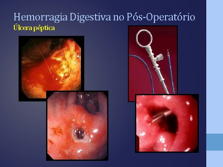 Hemorragia Digestiva no Pós-Operatório Úlcera péptica 