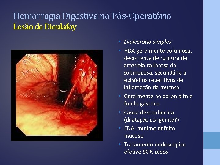 Hemorragia Digestiva no Pós-Operatório Lesão de Dieulafoy • Exulceratio simplex • HDA geralmente volumosa,