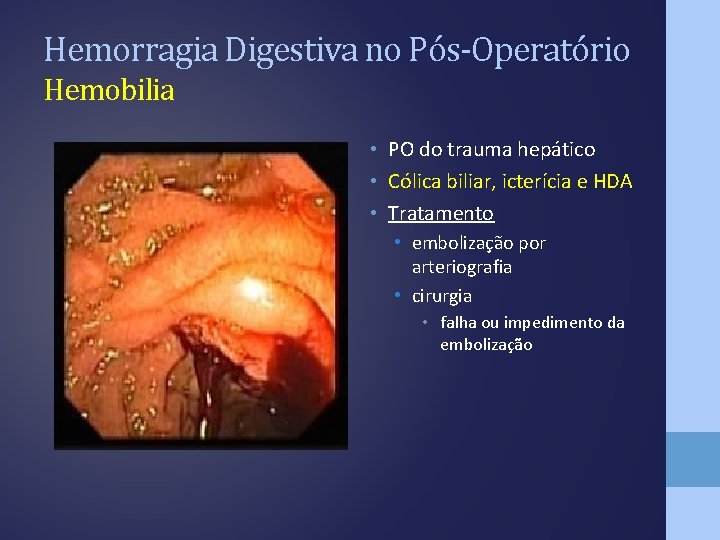 Hemorragia Digestiva no Pós-Operatório Hemobilia • PO do trauma hepático • Cólica biliar, icterícia