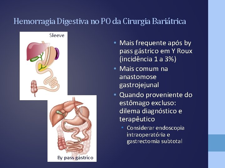 Hemorragia Digestiva no PO da Cirurgia Bariátrica Sleeve • Mais frequente após by pass