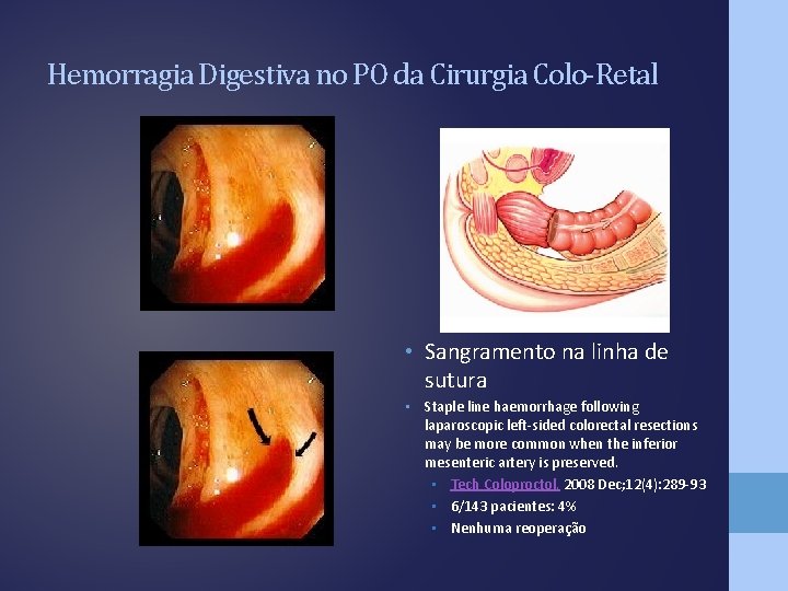 Hemorragia Digestiva no PO da Cirurgia Colo-Retal • Sangramento na linha de sutura •