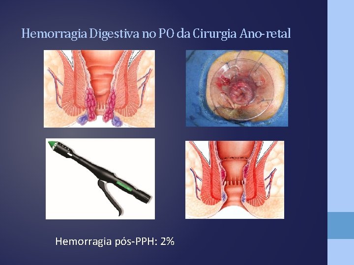 Hemorragia Digestiva no PO da Cirurgia Ano-retal Hemorragia pós-PPH: 2% 