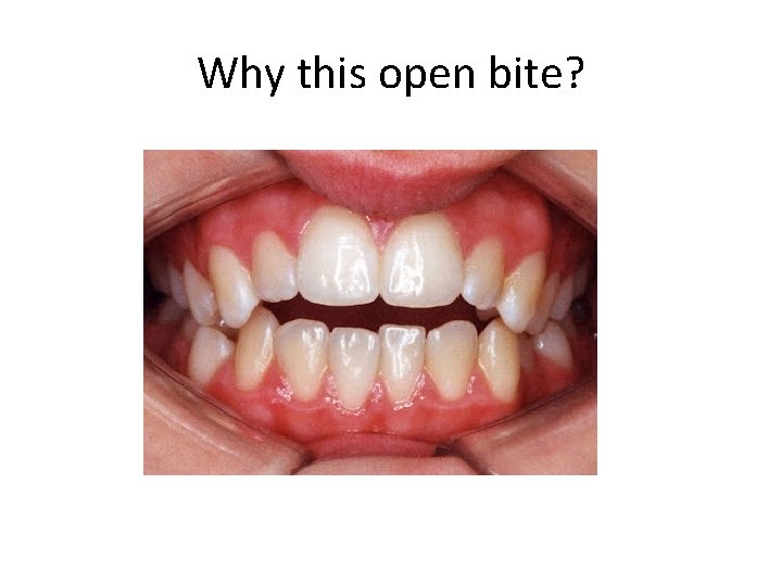 Why this open bite? 