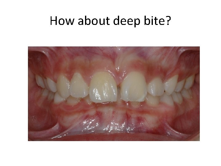 How about deep bite? 