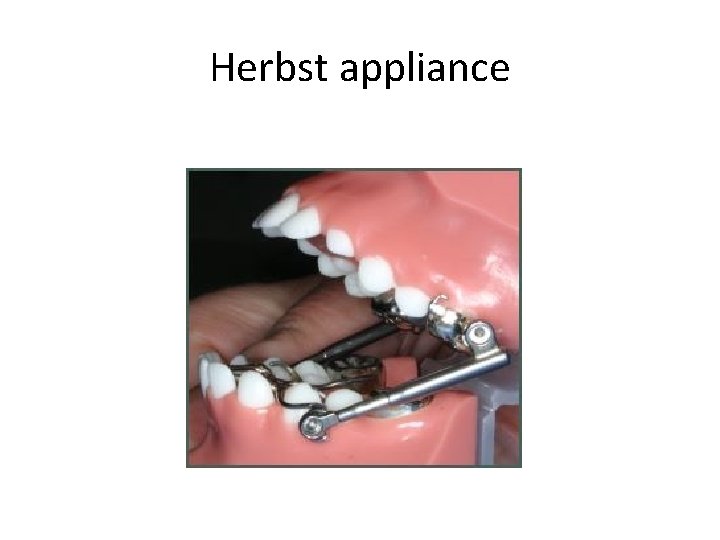 Herbst appliance 