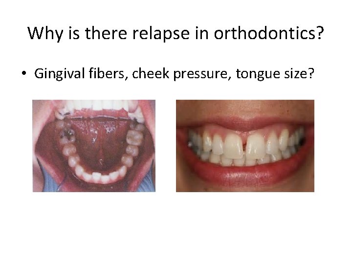 Why is there relapse in orthodontics? • Gingival fibers, cheek pressure, tongue size? 