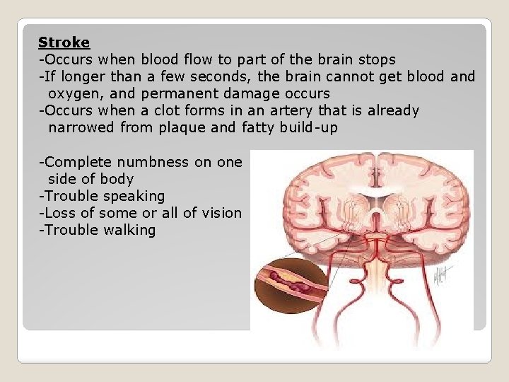 Stroke -Occurs when blood flow to part of the brain stops -If longer than