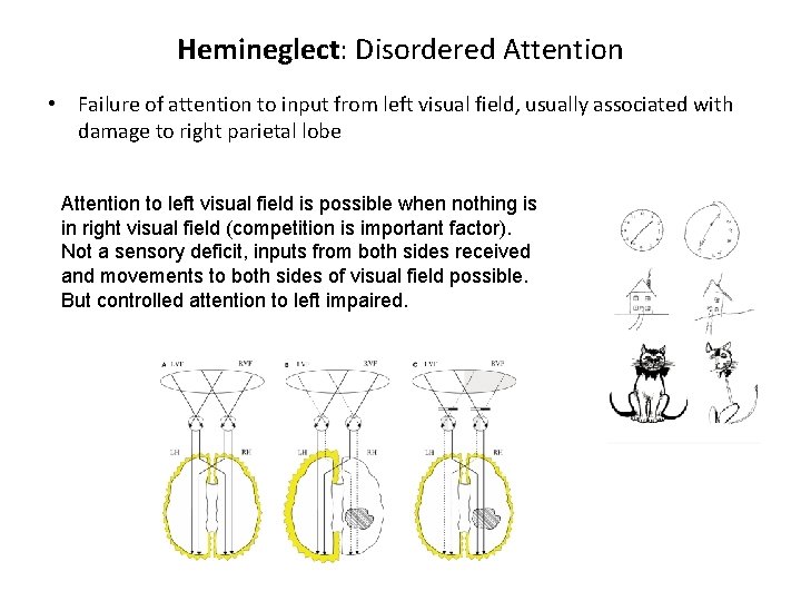 Hemineglect: Disordered Attention • Failure of attention to input from left visual field, usually