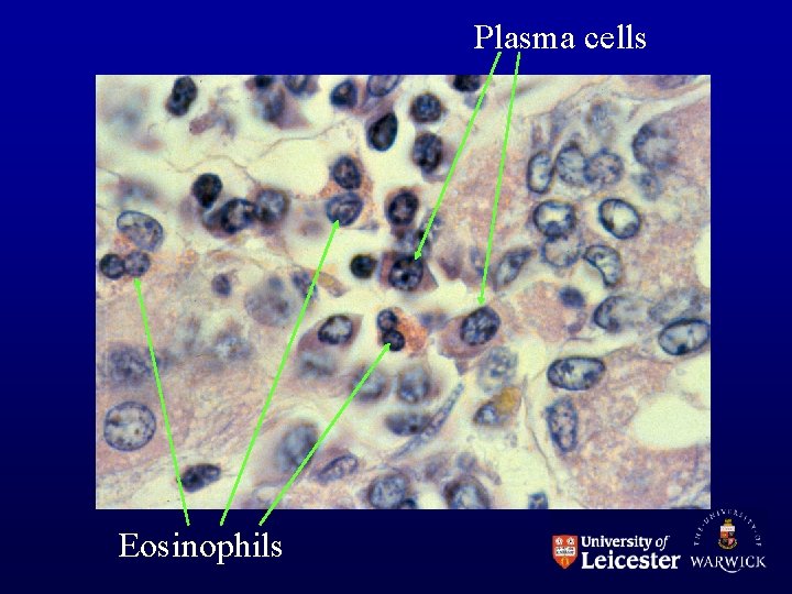 Plasma cells Eosinophils 