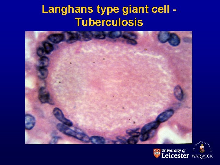 Langhans type giant cell Tuberculosis 