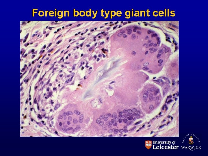 Foreign body type giant cells 
