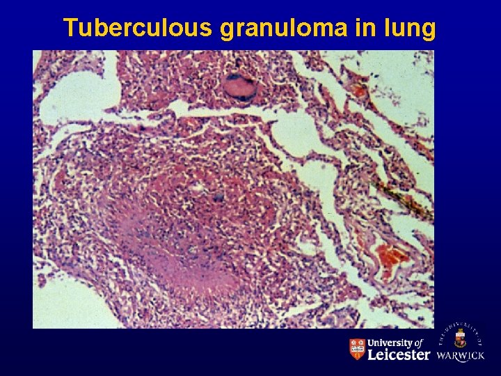 Tuberculous granuloma in lung 