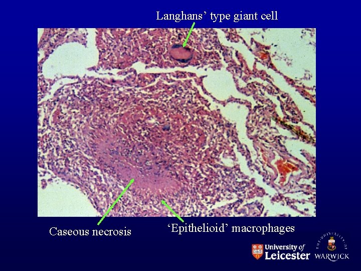 Langhans’ type giant cell Caseous necrosis ‘Epithelioid’ macrophages 